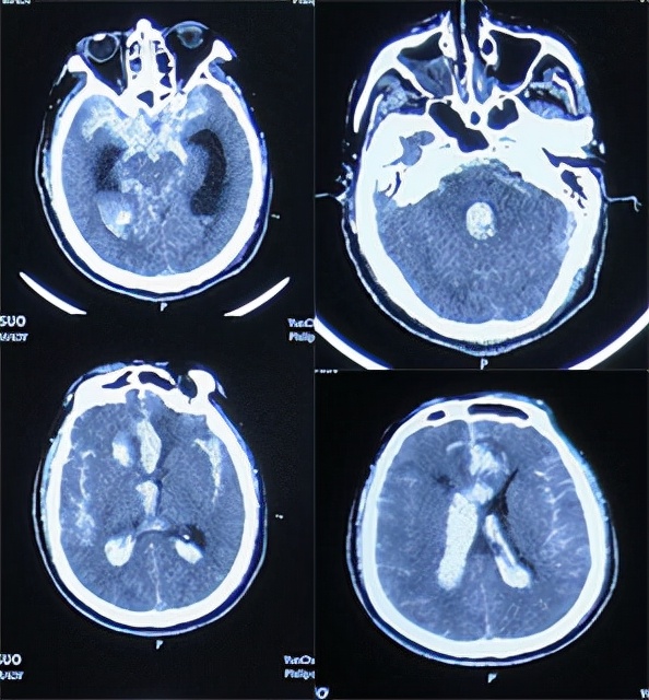 前交通动脉瘤破裂后开颅治疗风险,脑前交通动脉瘤破裂出血