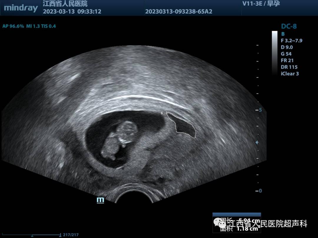 孕囊旁积液饮食,孕囊旁有积液可以吃补血药吗