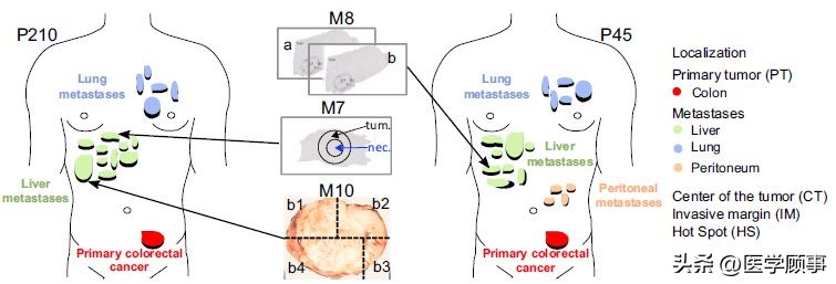 《Cell》揭示免疫选择压力下转移癌进化史