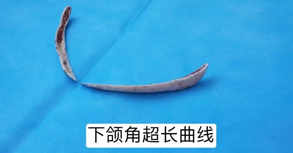 下颌角整形全过程视频,下颌整形手术的护理措施有哪些