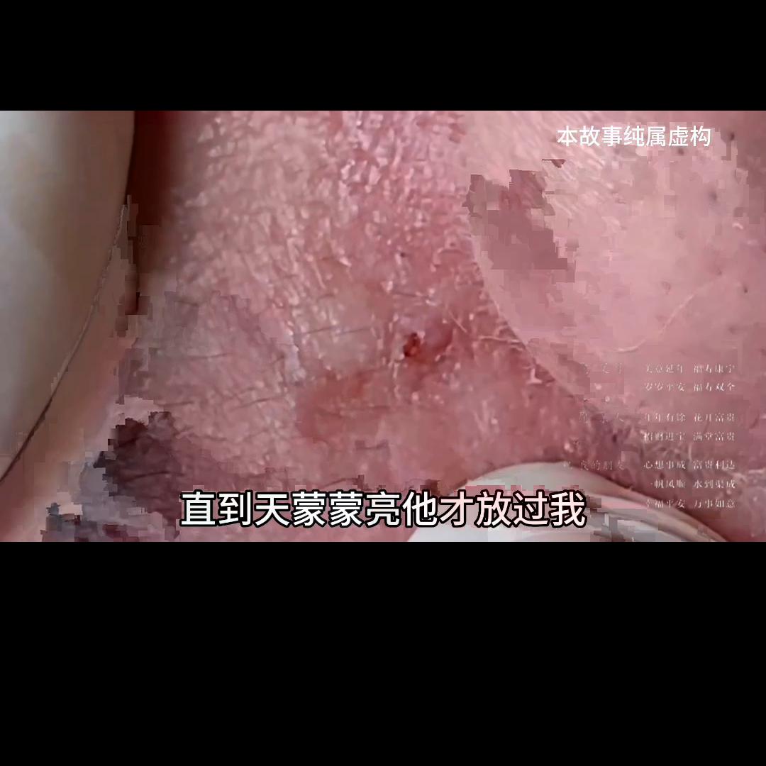 📖安安如招后续知乎#粉刺针的正确使用方法