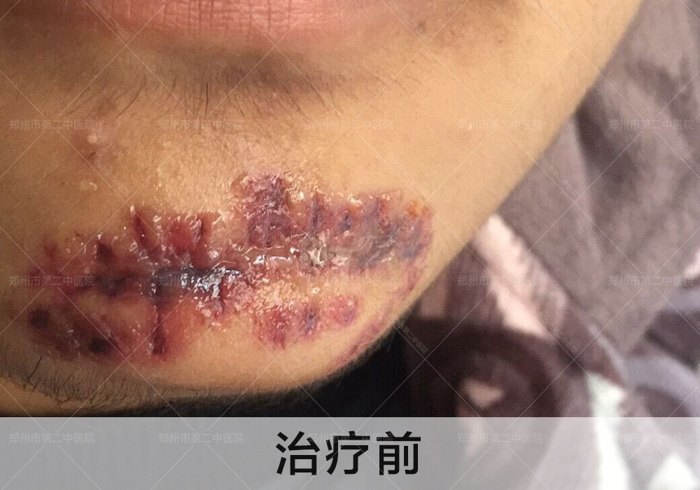 郑州哪个医院祛缝针疤最好,郑州第二中医院怎么祛疤痕