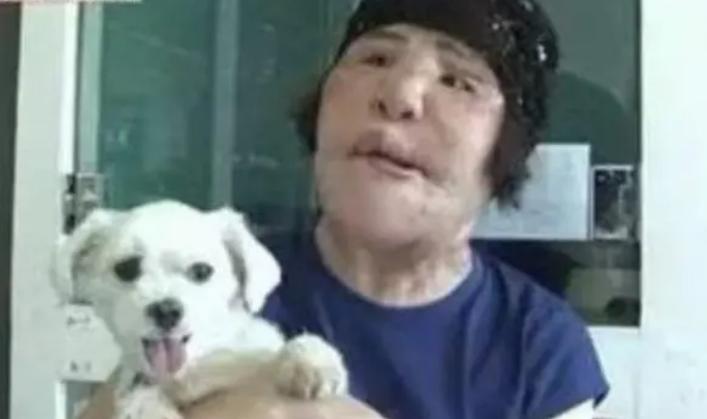 韩慧景整容是打了玻尿酸了吗,韩慧景整容案例