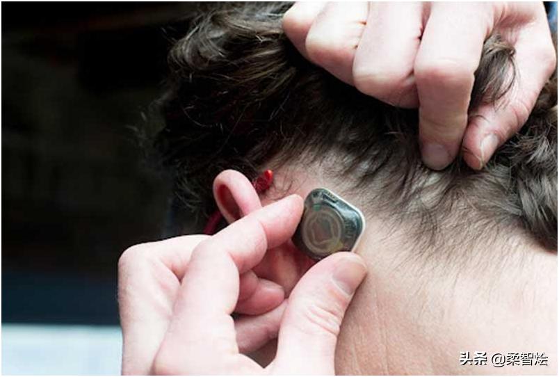 Epitel完成1250万美元的A系列融资，用于癫痫检测可穿戴设备