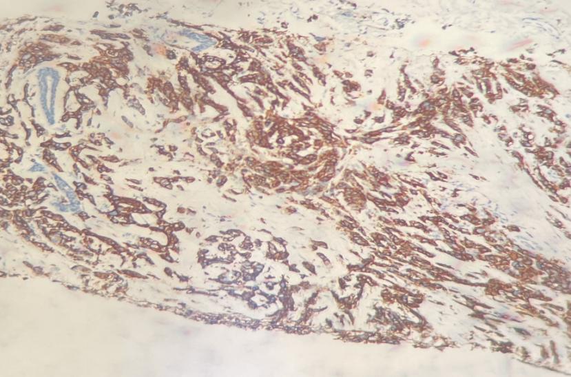 汉曲优曲妥珠单抗治疗效果,her2阳性乳腺癌新辅助治疗的启示