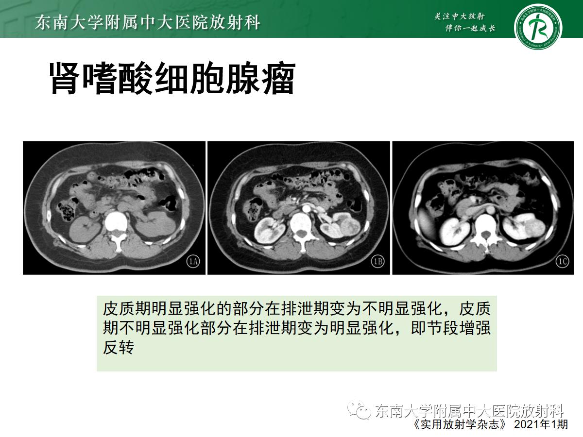 周利群谈肾嫌色细胞癌ct特点,好文分享值得深思