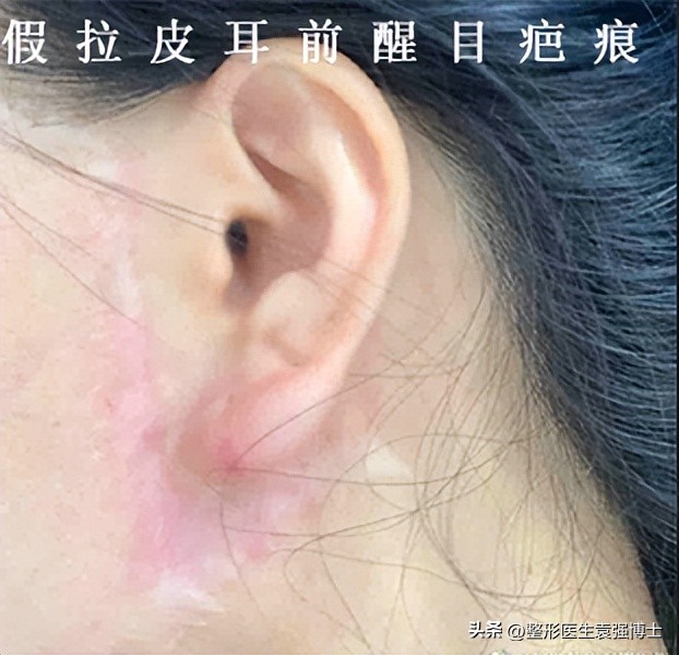 拉皮不剥离会留疤明显吗,拉皮手术如何防止留疤