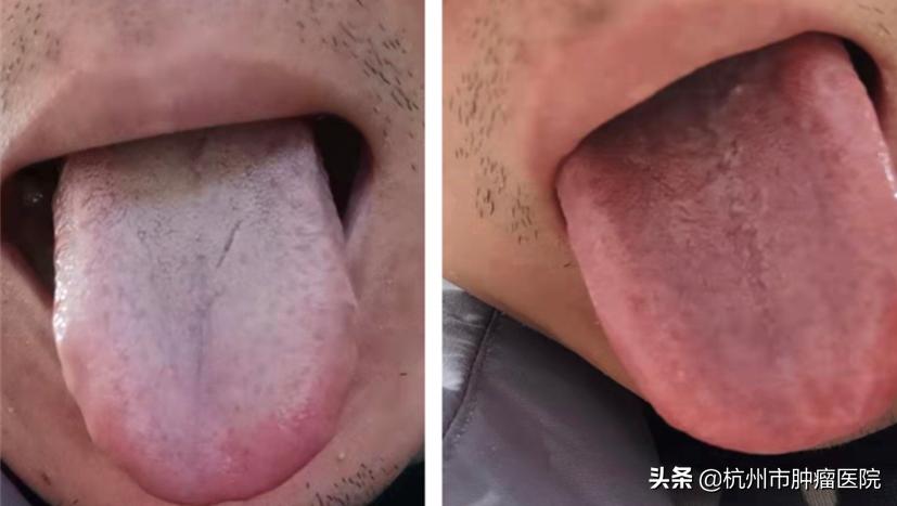 宝宝脾胃总是弱舌苔又厚怎么调理,脾胃不好导致舌苔发白怎么治