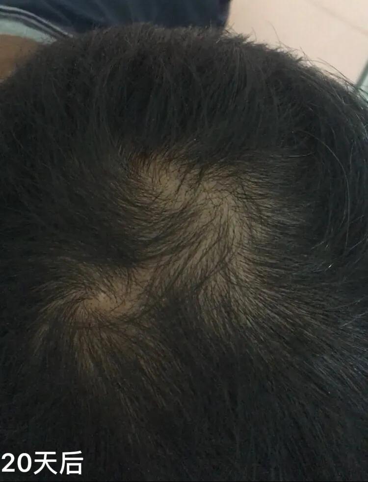 脱发的人日常注意4点,脱发的今日心得100字