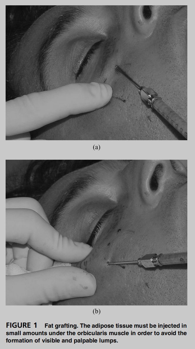 印第安纹解剖学,印第安纹分型对策