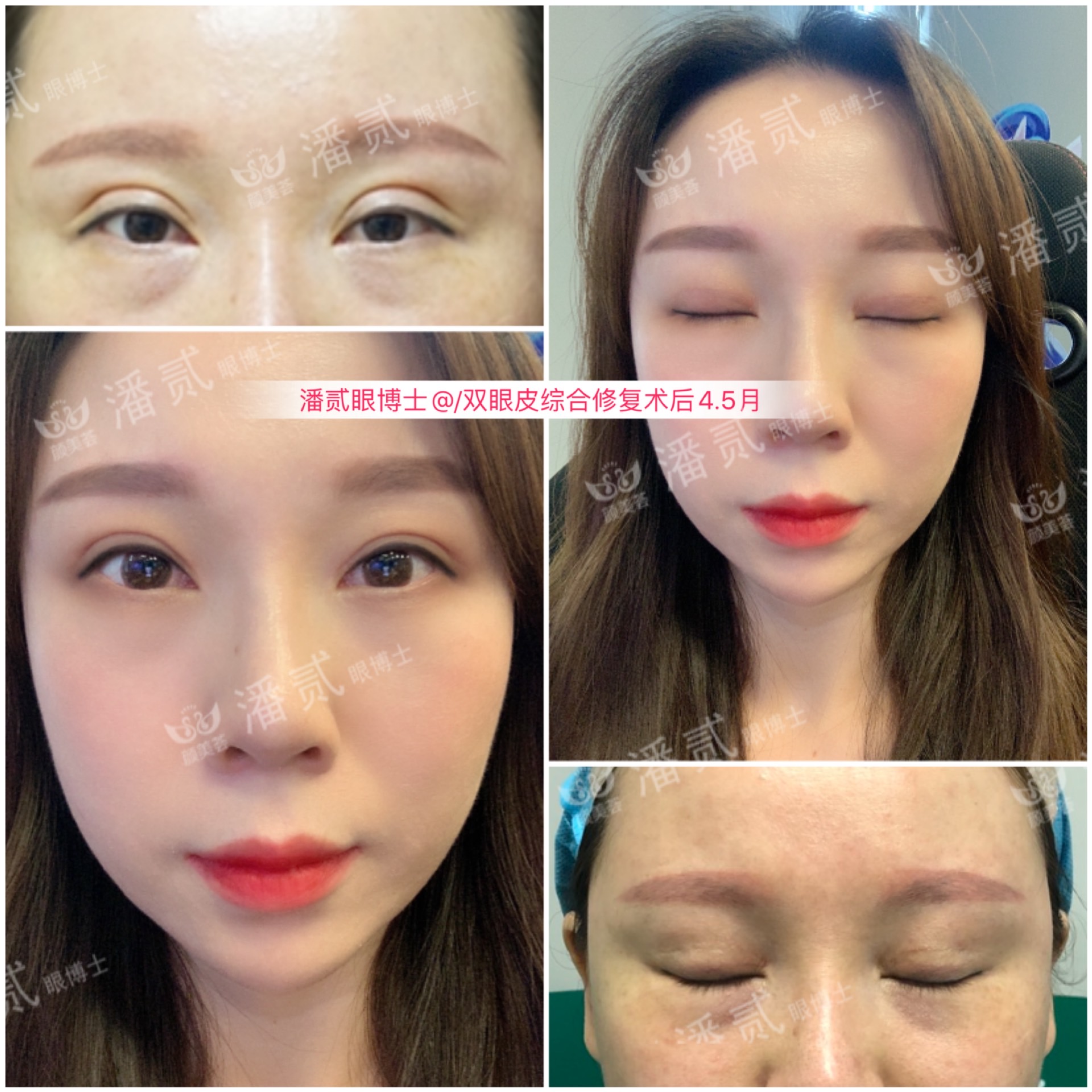 整容失败大眼女,整容12次失败之后长什么样