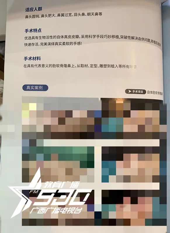 女子花1万隆鼻后山根塌陷,女子花9万多隆鼻