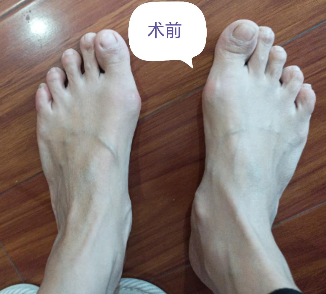 脚趾外翻疼痛怎么治,脚趾外翻肿痛怎么消肿