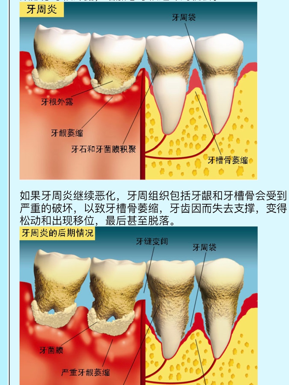 改善牙龈出血美白的牙膏科普,最好的防治牙龈牙周病的牙膏