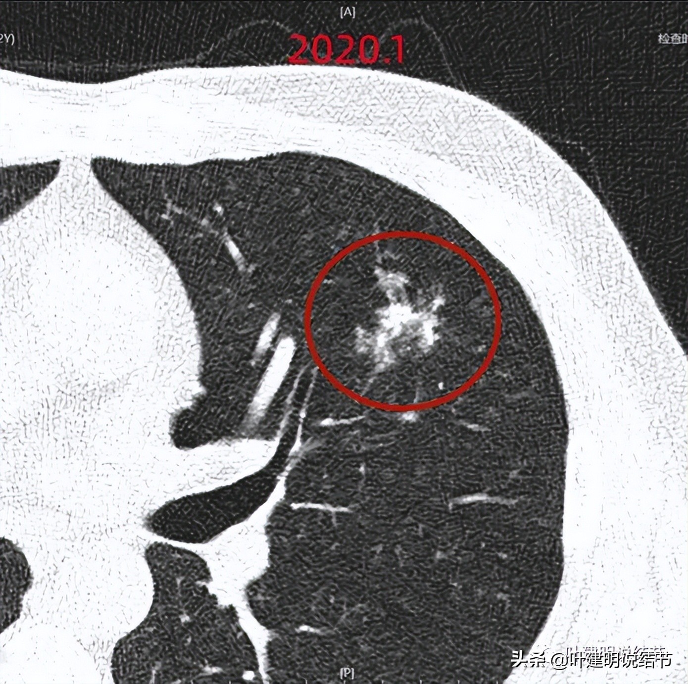 肺穿刺活检良性,肺穿刺活检容易形成气胸吗