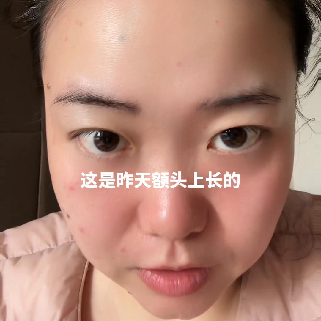 腰果过敏吃什么中药,过敏了敢不敢吃腰果