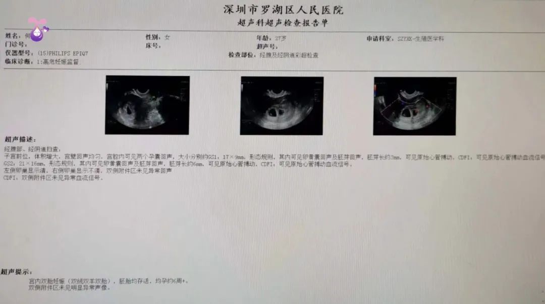 监测排卵+指导同房后喜怀双胎