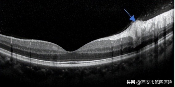 #新冠防疫手册#33岁女士“阳康”后视力下降、模糊、黑影……