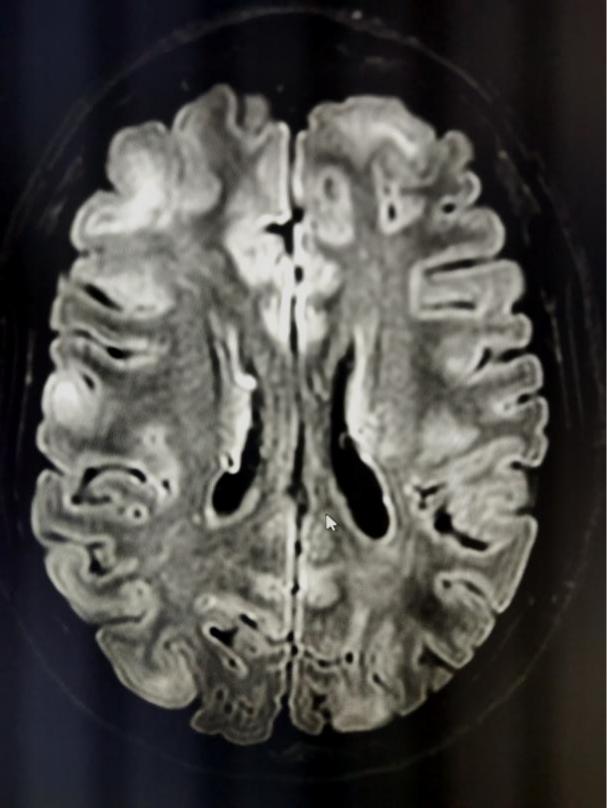 孩子反复抽搐智力低下还能恢复吗,反复抽搐并发症