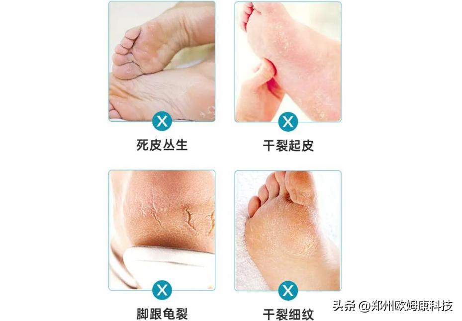 夏天脚裂能穿防裂袜吗,袜子男士纯棉防裂袜