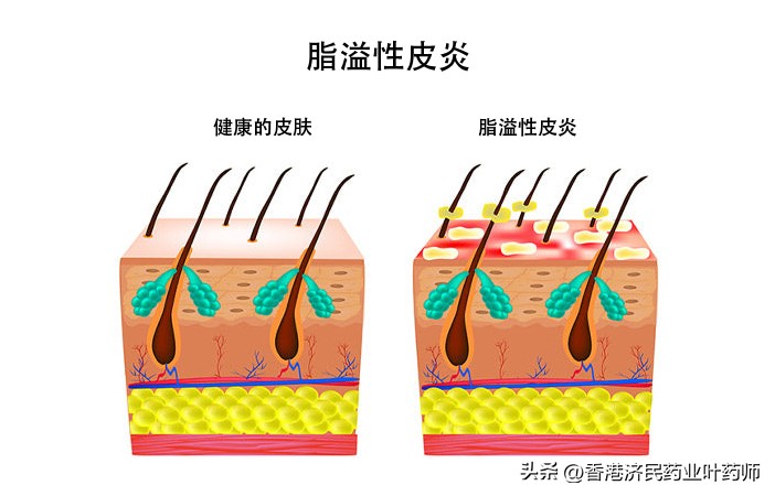 可快速清除疾病并显著减少瘙痒！Zoryve泡沫剂获准用于脂溢性皮炎