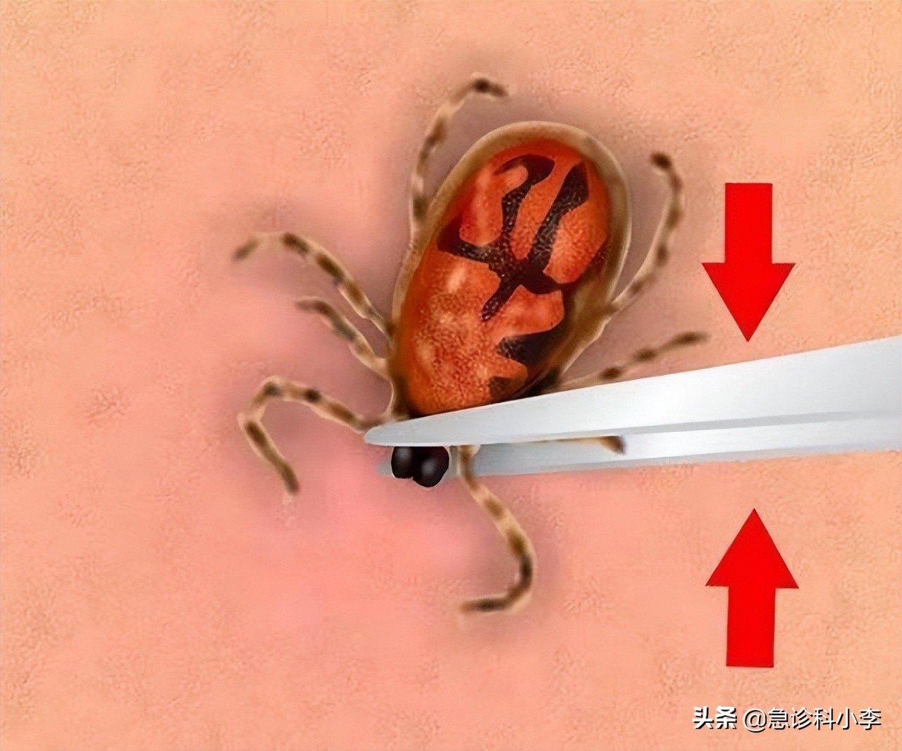 蜱虫咬人死亡率多少,蜱虫咬后死亡率新闻