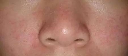 为什么会毛孔粗大长粉刺,为什么会毛孔粗大油光满面