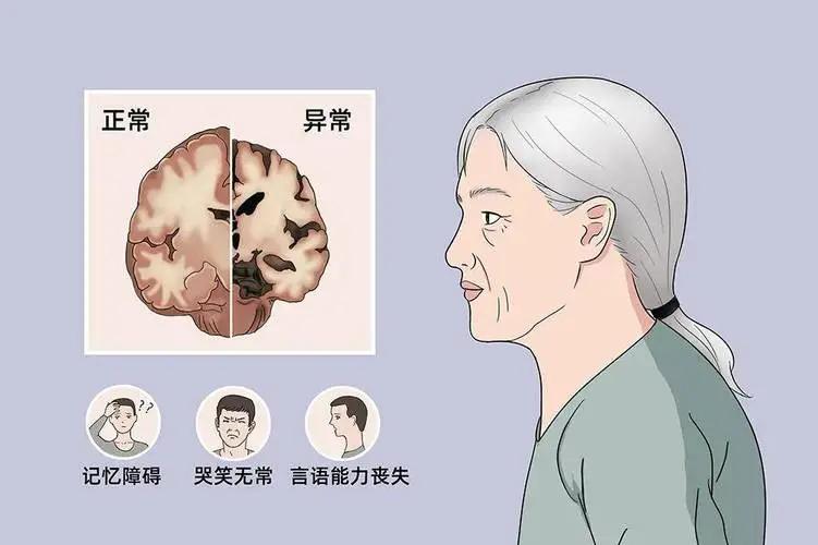 脑萎缩不可轻视应尽早防治,岁数大了脑萎缩吃什么药