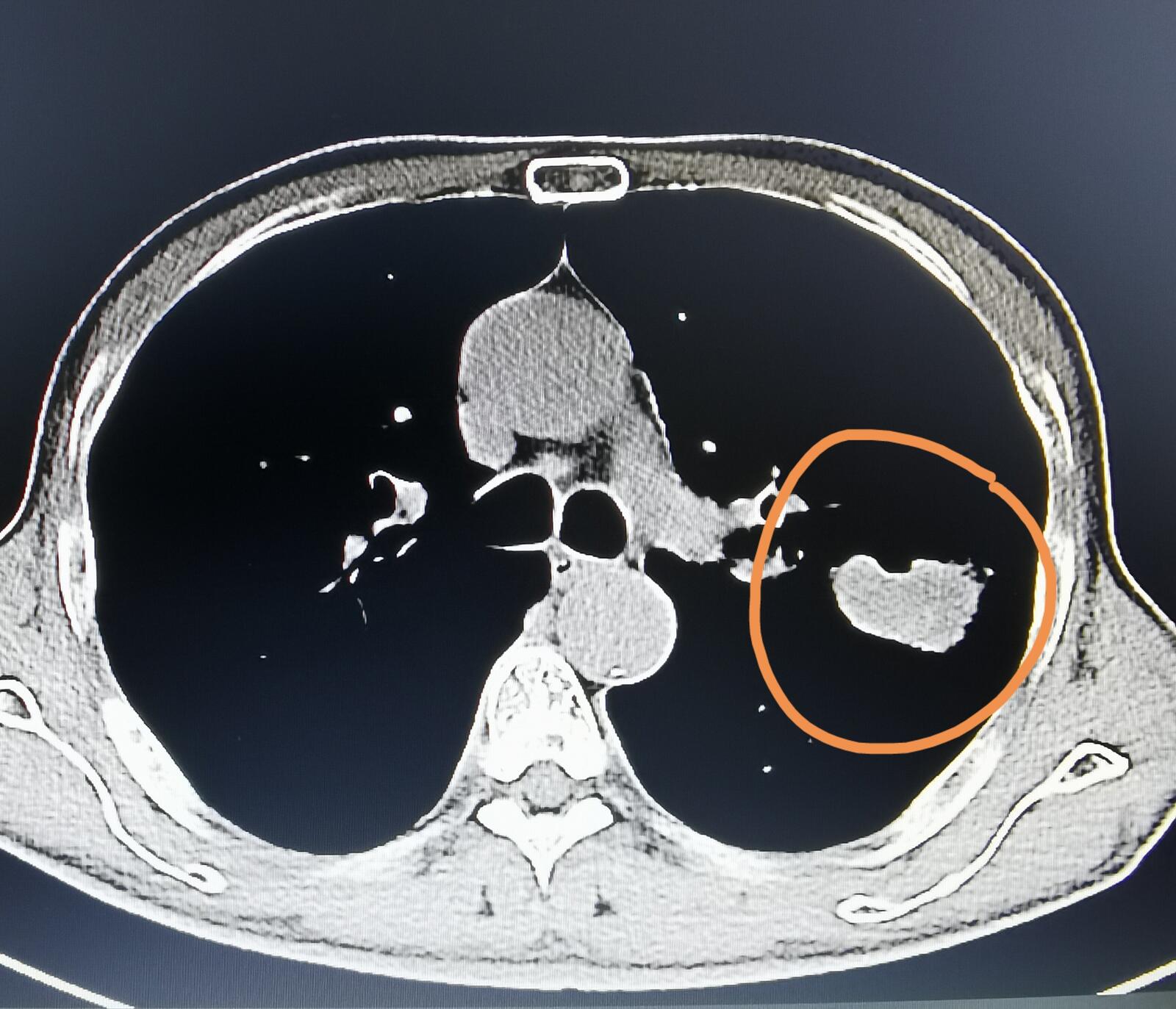 刘懿博士肺癌晚期,刘懿博士说肺癌全集