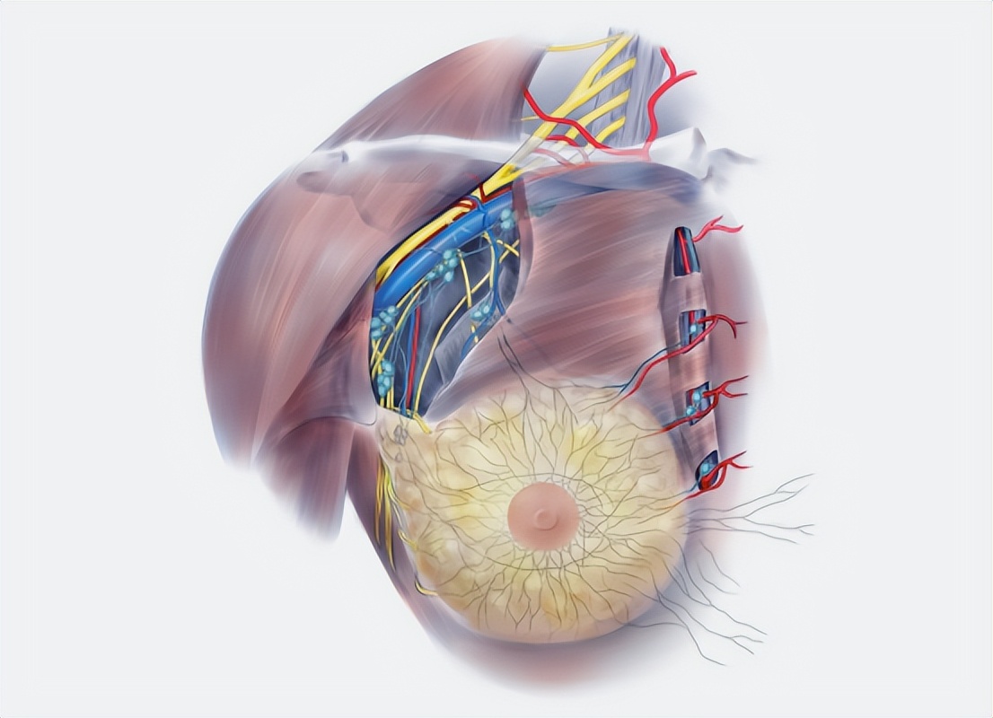 异时性双侧原发性乳腺癌10年,双侧原发性乳腺癌需要化疗吗