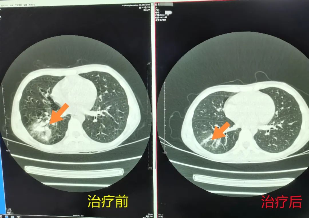 8岁女孩断断续续咳嗽近两年,8岁半夜咳嗽一个方法止咳