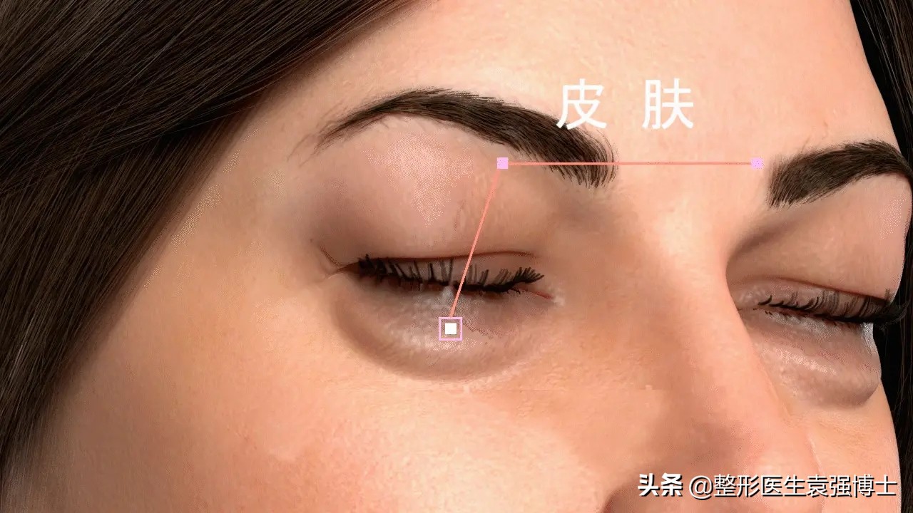 祛眼袋手术的真相,眼袋去除手术真实案例