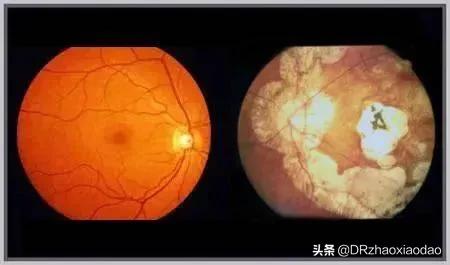 还有人以为脉络膜增厚是坏事吗？看完这篇再说吧