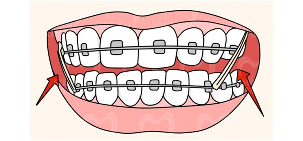 暑期是孩子矫牙的最佳时机吗,14岁整牙对发育有什么影响