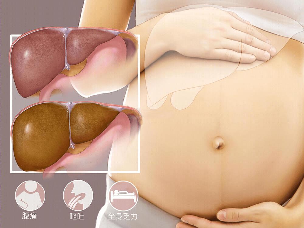 孕期脂肪肝是什么症状,孕期脂肪肝怎么引起的