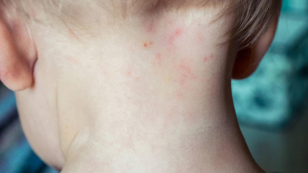 湿疹痱子如何辨别,湿疹和痱子怎么能分清楚