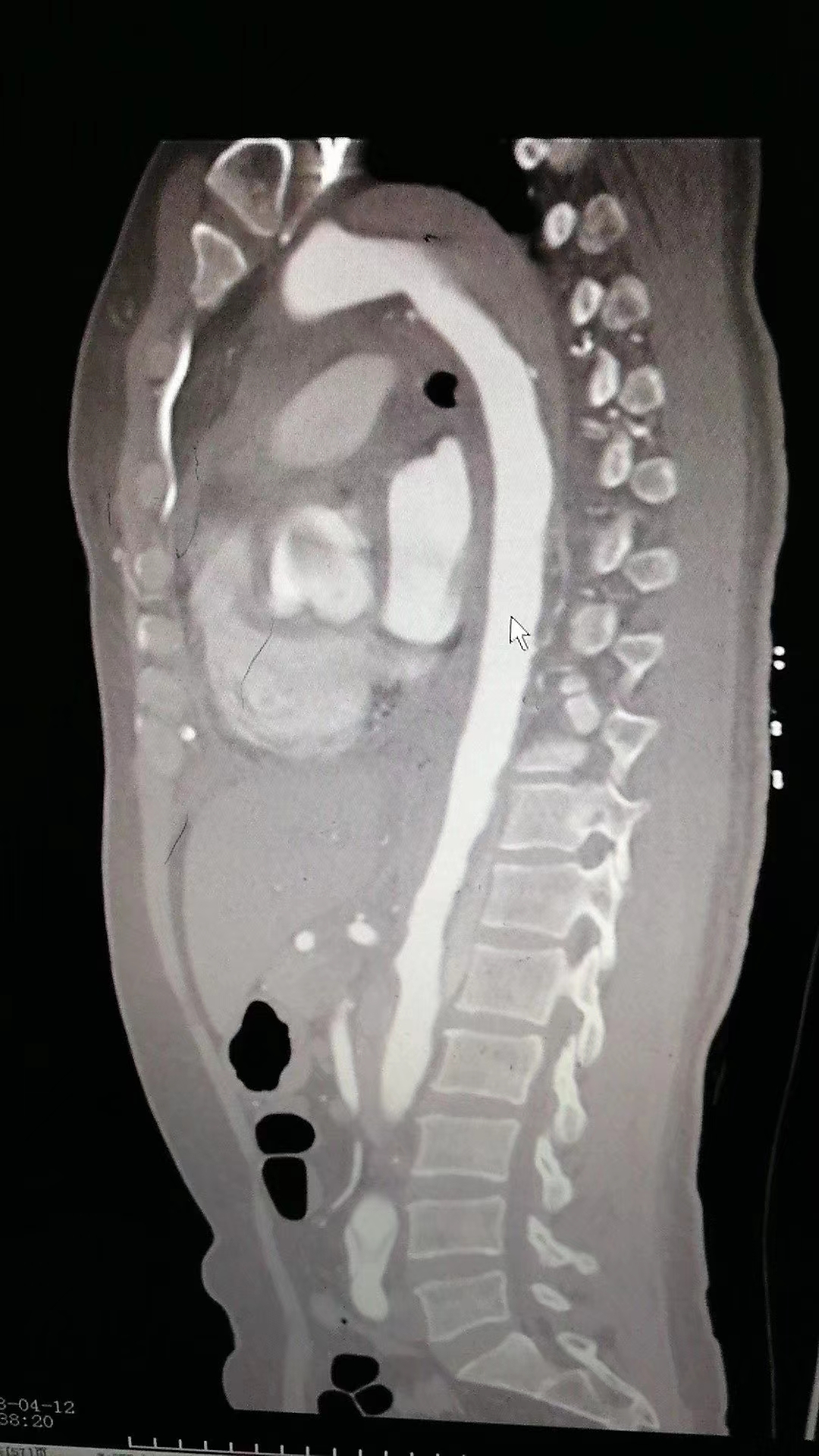 主动脉夹层心率太快,主动脉夹层的凶险