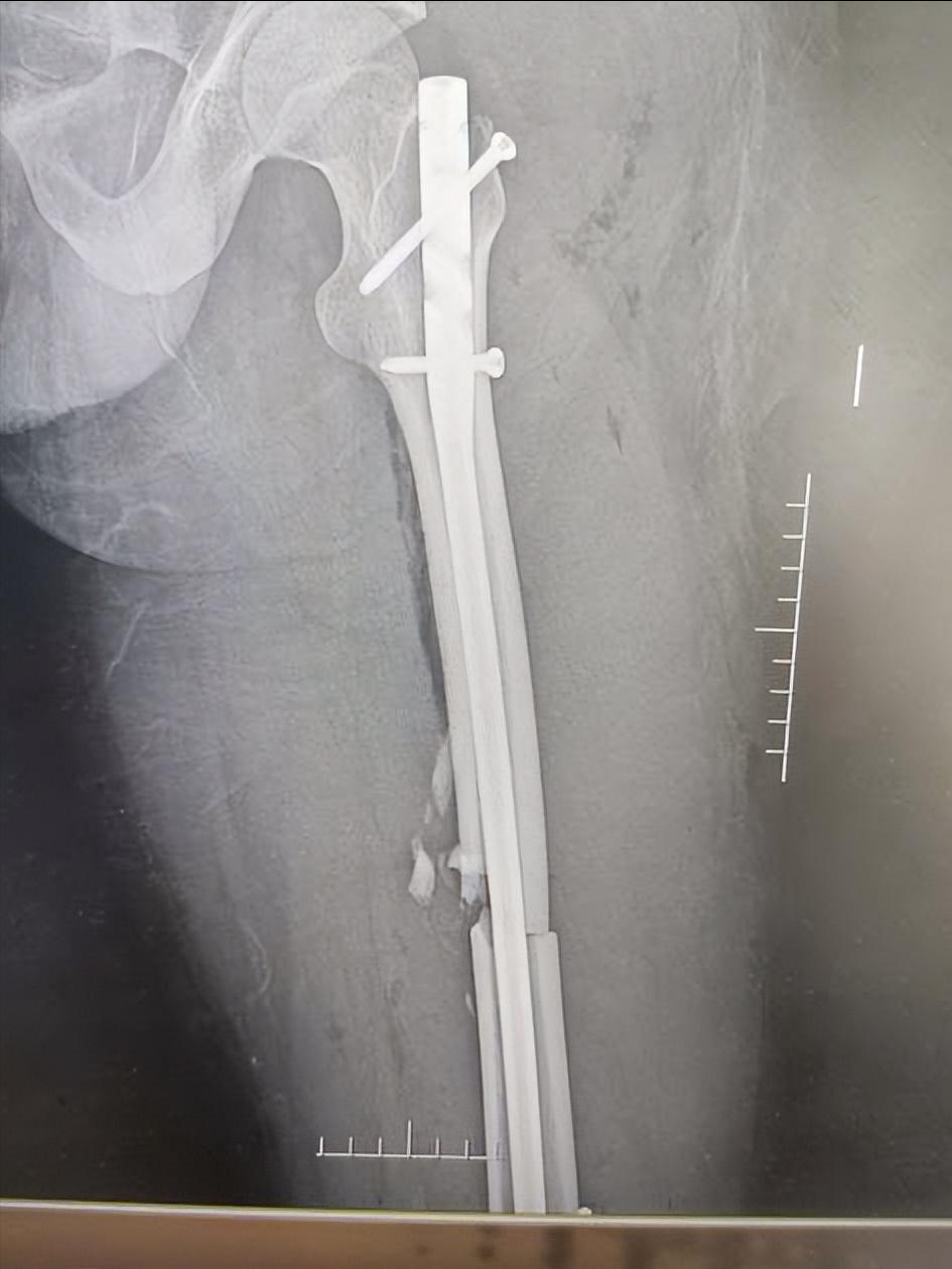 儿童股骨干粉碎性骨折对位不太好,儿童股骨干骨折石膏固定