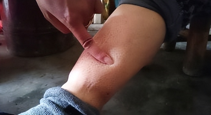 治疗肾阳虚有什么经典名方,治疗肾阳虚的经典方子