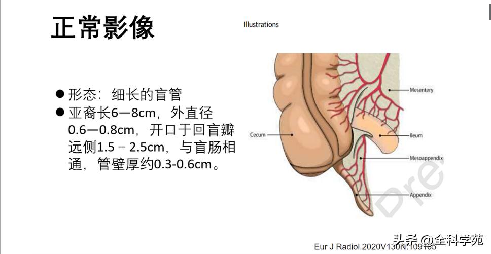 阑尾炎的讲解,关于阑尾炎的讨论总结