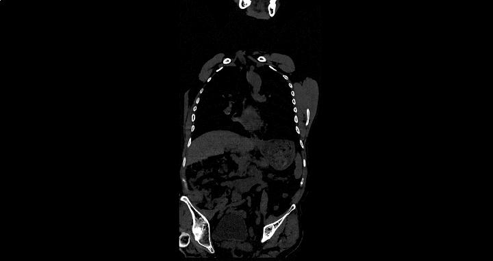 女性患强直和腰肌劳损,女性因为臀部疼痛导致疾病