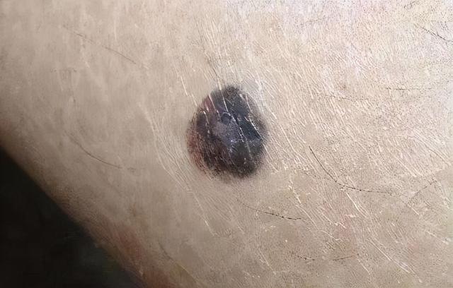 留意黑痣癌变五个重要形态,黑痣比较大才需要引起重视吗