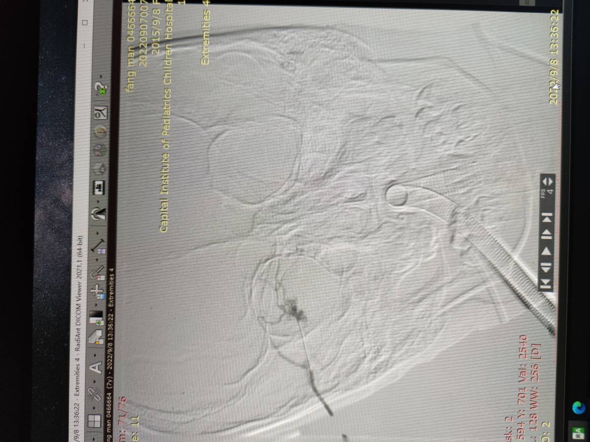 成人先天性眼睛长了血管瘤怎么办,新生儿血管瘤和先天性血管瘤