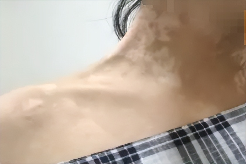 产后为什么会出现白斑？准妈妈哺乳期得了白癜风怎么办？