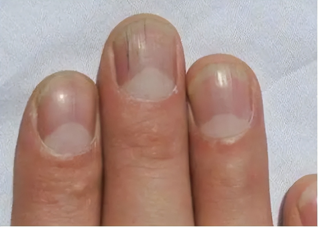 指甲竖纹与肝脏的关系,指甲盖有竖纹凸起是肝有病吗