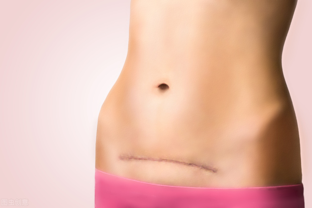 第一胎剖宫产，第二胎需要这些条件才能顺产