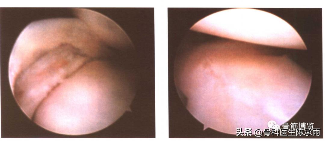 盘状半月板撕裂一级,半月板层裂愈合概率