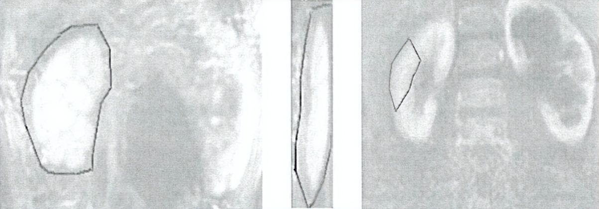 中医治疗宝宝肾积水输尿管狭窄,小儿肾积水和输尿管扩张怎么治疗
