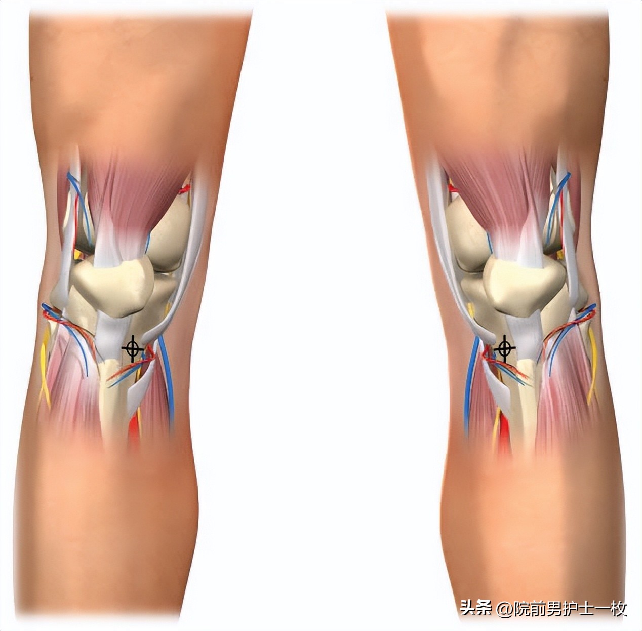 骨髓腔穿刺急救,骨髓腔穿刺适应症和禁忌症