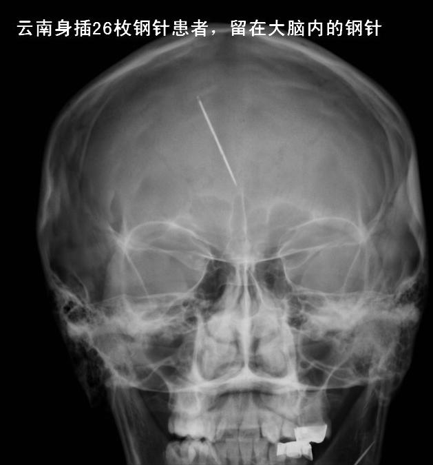 云南女子体内26根绣花针凶手是谁,云南女子缝衣针